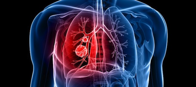 Lung Disease Responsible For 1 In 10 Deaths