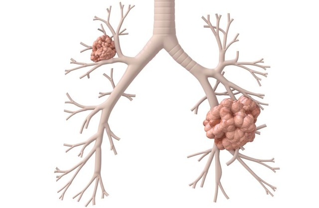 Lung Cancer Know The Symptoms, It’s Not Just Smokers At Risk!